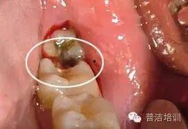 成人长蛀牙视频真实,真实视频揭示口腔健康危机