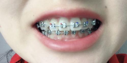 成人牙齿整形办法视频大全,成人牙齿整形视频攻略大全