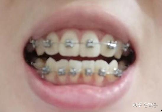 成人牙齿整形办法视频大全,成人牙齿整形视频攻略大全