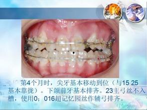 成人排牙视频大全,揭秘牙齿矫正全过程
