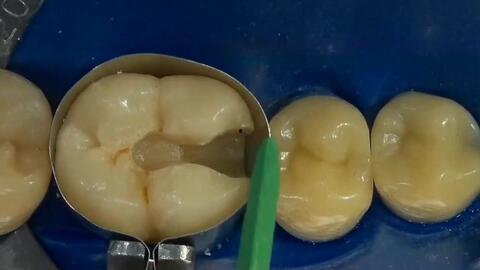 成人乳牙怎么补牙洞视频