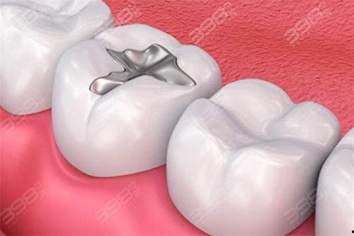 成人乳牙怎么补牙洞视频